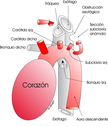1.3.1.-subclavia-drcha-anomala