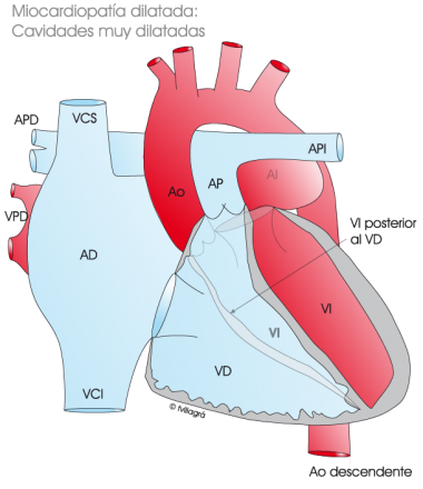 1.4.2.-corazon-con-miocardiopatia-dilatada.a.1