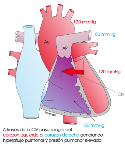 1.5.2.-hipertension-pulmonar-por-hiperaflujo