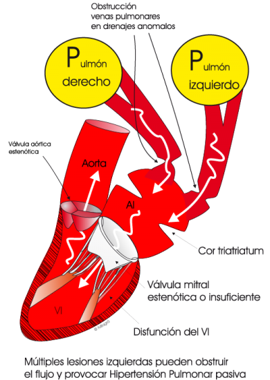 1.5.2.-hipertension-pulmonar-por-obstruccion-izquierda