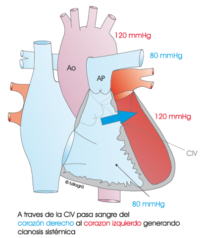 1.5.2.-hipertension-pulmonar-severa