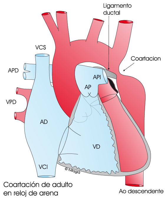 Coartación de Aorta nativa y Re-coartación en adultos. Seguimiento a largo  plazo - La web de las Cardiopatías Congénitas
