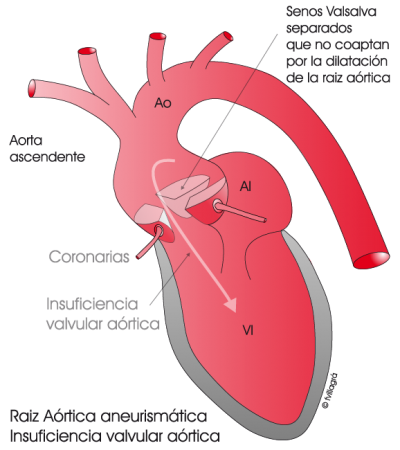 2.9.-raiz-aortica-aneurismatica.a.1