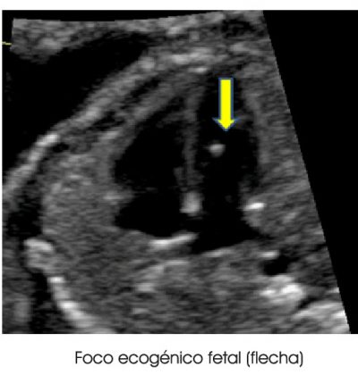 3.1.3.-foco-ecogenico-fetal