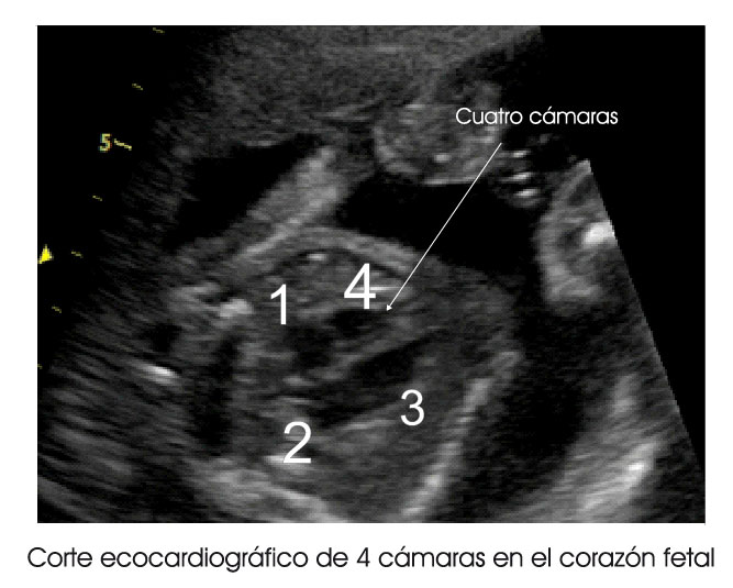 3.1.4.-corte-de-4-camaras-en-2D-en-corazon-fetal.jpg