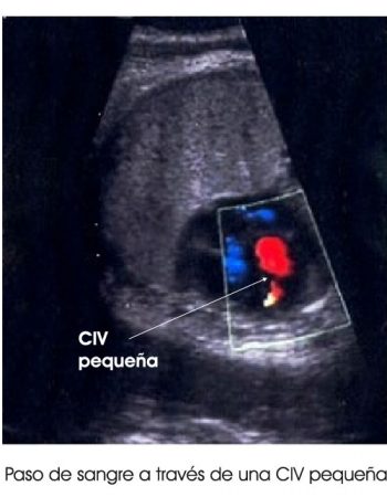3.1.5.civ-pequena-en-eco-fetal