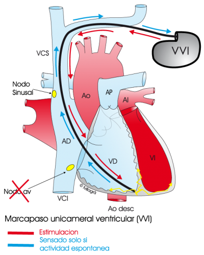 5.4.2.-marcapaso-unicameral-ventricular