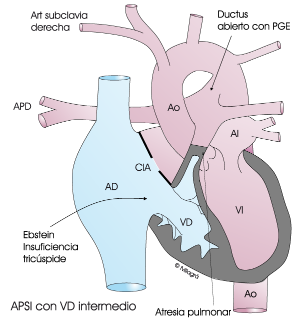 Atresia Pulmonar Con Septo Intacto Web Cardiopat as Cong nitas