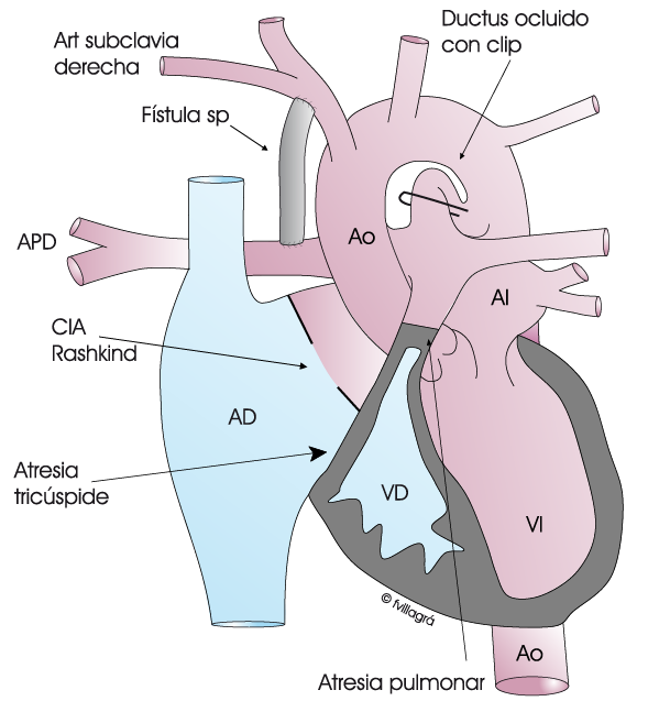 Atresia Pulmonar Con Septo Intacto Web Cardiopat as Cong nitas