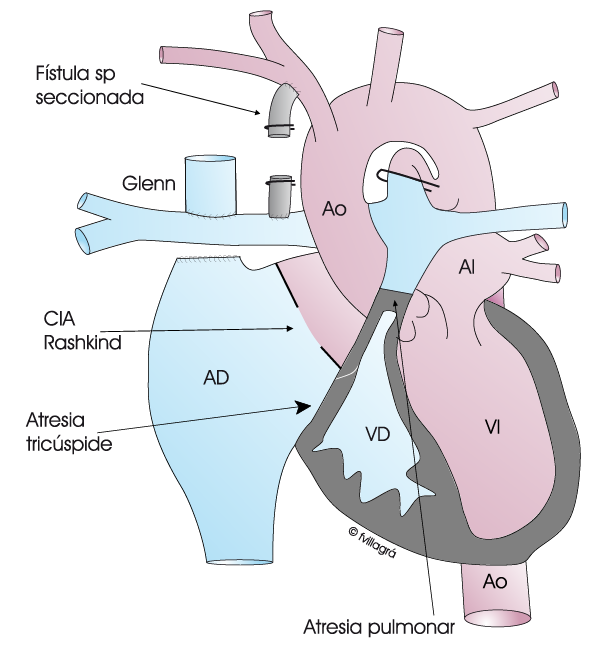 Atresia Pulmonar Con Septo Intacto Web Cardiopat as Cong nitas